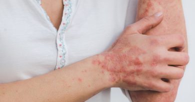 Łuszczyca skóry – czym jest, jakie daje objawy i jak się ją leczy? Łuszczyca skóry